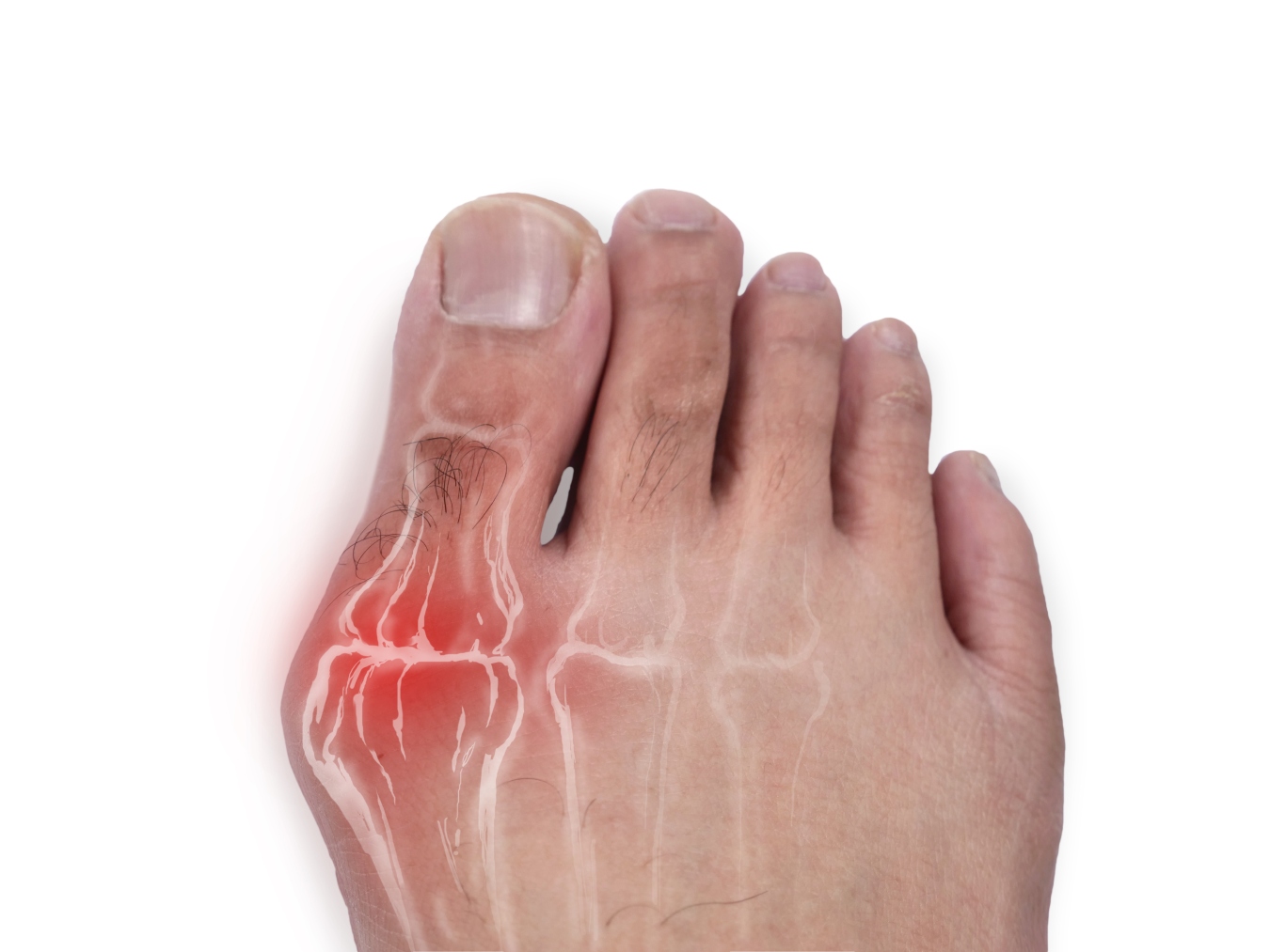 Bunion Treatments