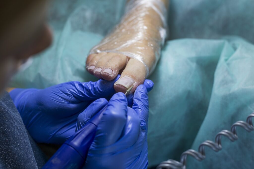 Ingrown Toenail Treatments