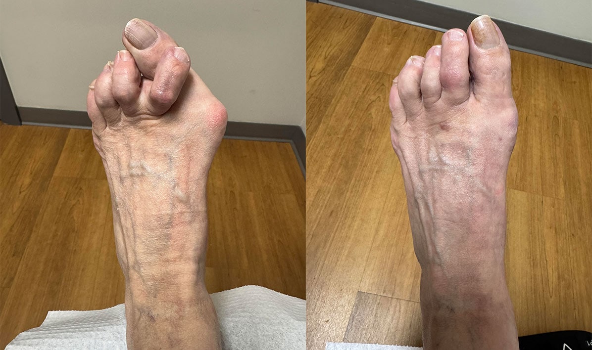 Bunion - Before and After 13